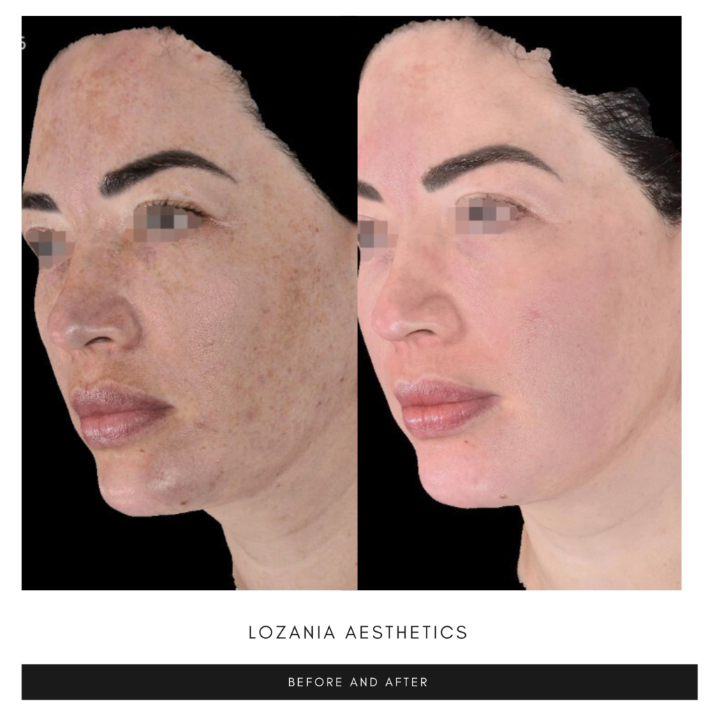 Comparativa antes y después del perfil facial femenino con ojos pixelados: a la izquierda se ven manchas, poros y textura irregular; a la derecha, piel más lisa, uniforme y luminosa. Logro de medicina estética facial y cuidado profesional de la piel en Lozania Centro Estético mediante tratamientos no quirúrgicos, evaluación médica personalizada, limpieza facial y tecnología estética avanzada como el lifting no quirúrgico Liftera 2.