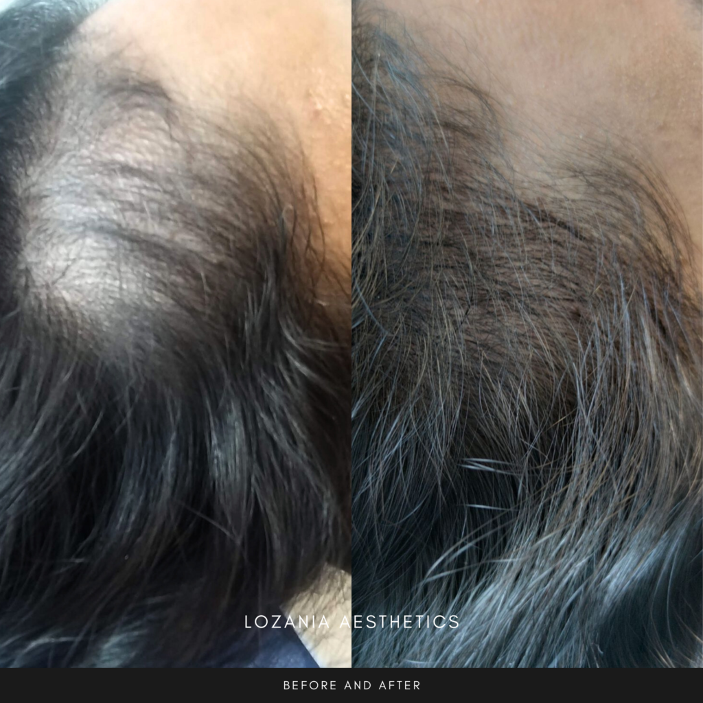 Comparativa antes y después del cuero cabelludo: a la izquierda se ve adelgazamiento con áreas claras; a la derecha, mayor densidad capilar y piel más saludable tras tratamientos no quirúrgicos en Lozania Centro Estético, con evaluación médica personalizada y tecnología estética avanzada enfocada en el cuidado de la piel del cuero cabelludo.