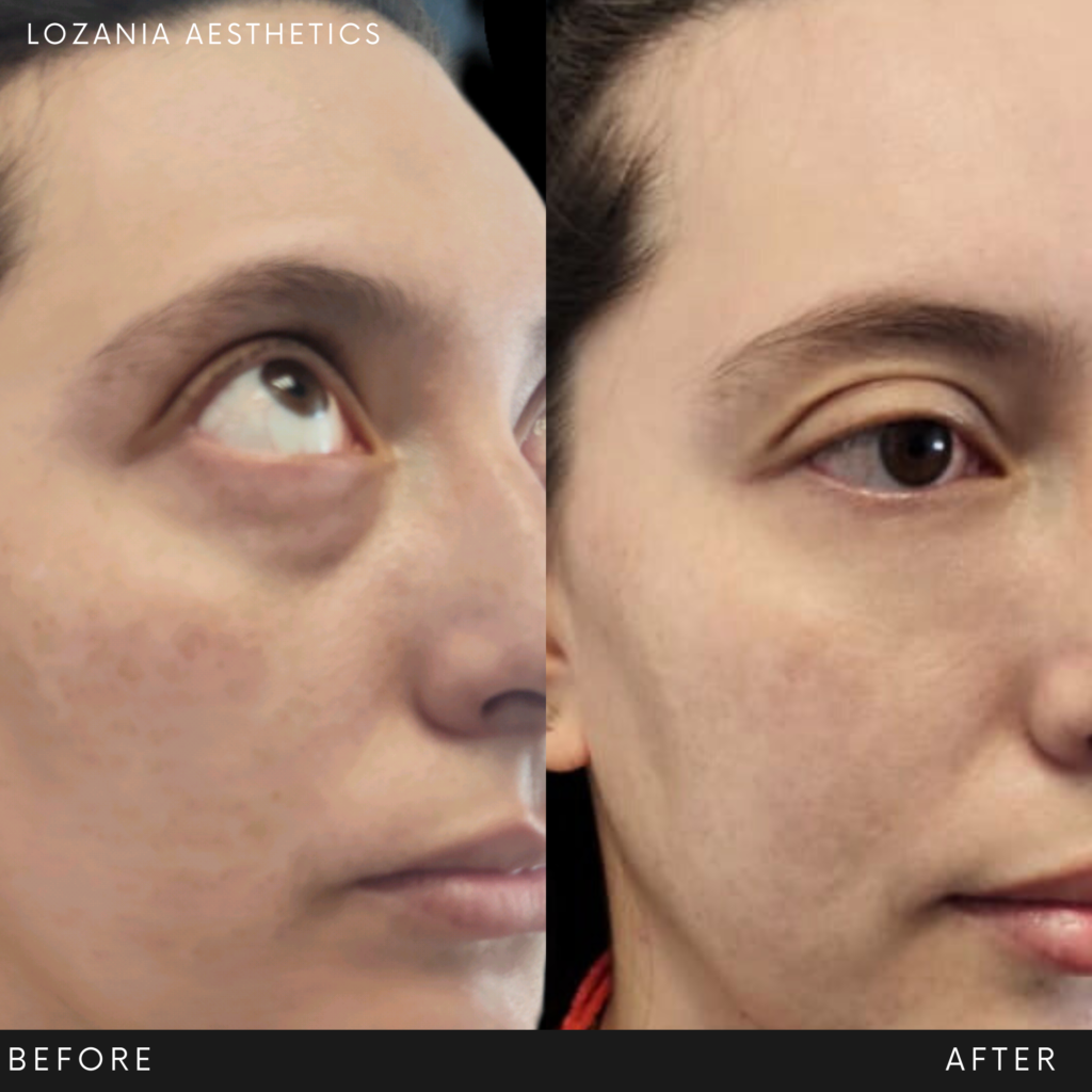 Antes y después en primer plano del contorno de ojos: a la izquierda se notan ojeras, bolsas y textura irregular; a la derecha, piel más lisa y uniforme. Imagen de Lozania Centro Estético que muestra resultados de medicina estética facial con tratamientos no quirúrgicos y cuidado de la piel, respaldados por evaluación médica personalizada y tecnología estética avanzada como lifting no quirúrgico Liftera 2, toxina botulínica o limpieza facial.