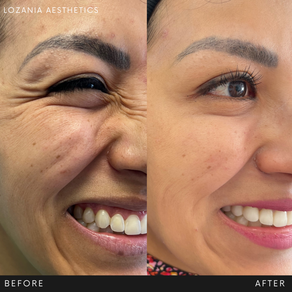 Comparativa antes y después del contorno de ojos de una mujer sonriendo en Lozania Centro Estético: arrugas de “patas de gallo” visiblemente suavizadas y piel más lisa y luminosa tras medicina estética facial con tratamientos no quirúrgicos (como toxina botulínica o lifting no quirúrgico Liftera 2), apoyo de cuidado de la piel y limpieza facial, con evaluación médica personalizada y tecnología estética avanzada.