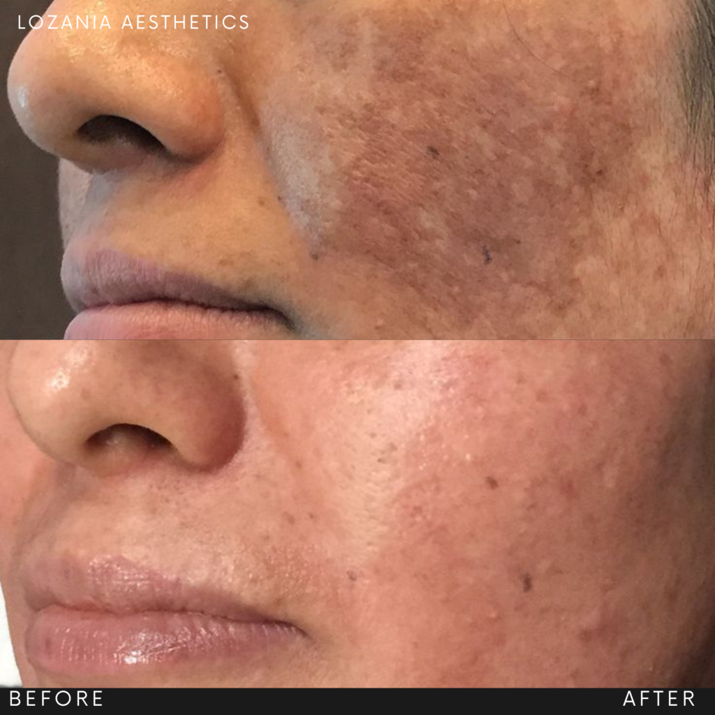 Primer plano comparativo antes y después de la mejilla y labios: disminuyen manchas y poros, mejora la textura y la luminosidad. Resultado de medicina estética facial en Lozania Centro Estético con tratamientos non quirúrgicos, limpieza facial y cuidado de la piel respaldados por tecnología estética avanzada y evaluación médica personalizada; el centro ofrece además opciones como toxina botulínica y lifting no quirúrgico Liftera 2 según indicación.