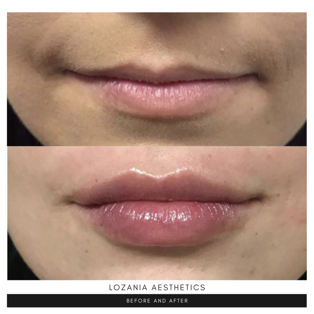Antes y después de un aumento de labios: se observa mayor volumen, hidratación y contorno natural. Procedimiento no quirúrgico de medicina estética facial en Lozania Centro Estético, con evaluación médica personalizada y tecnología estética avanzada para el cuidado de la piel.