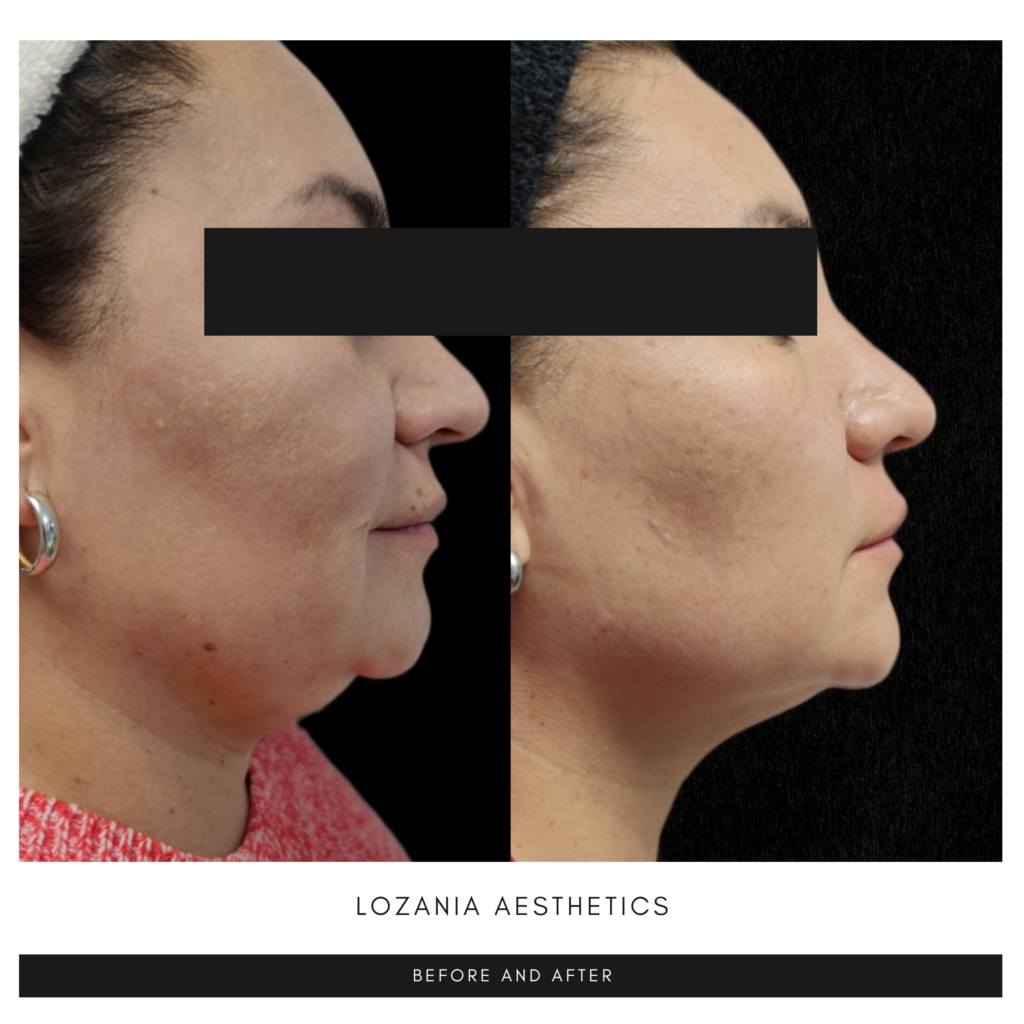 Antes y después en perfil de una mujer con ojos cubiertos: se observa reducción de papada, contorno mandibular más definido y piel más lisa tras tratamientos no quirúrgicos de medicina estética facial en Lozania Centro Estético. Imagen asociada a protocolos con evaluación médica personalizada y tecnología estética avanzada, que pueden incluir lifting no quirúrgico Liftera 2, toxina botulínica, limpieza facial y cuidado de la piel.