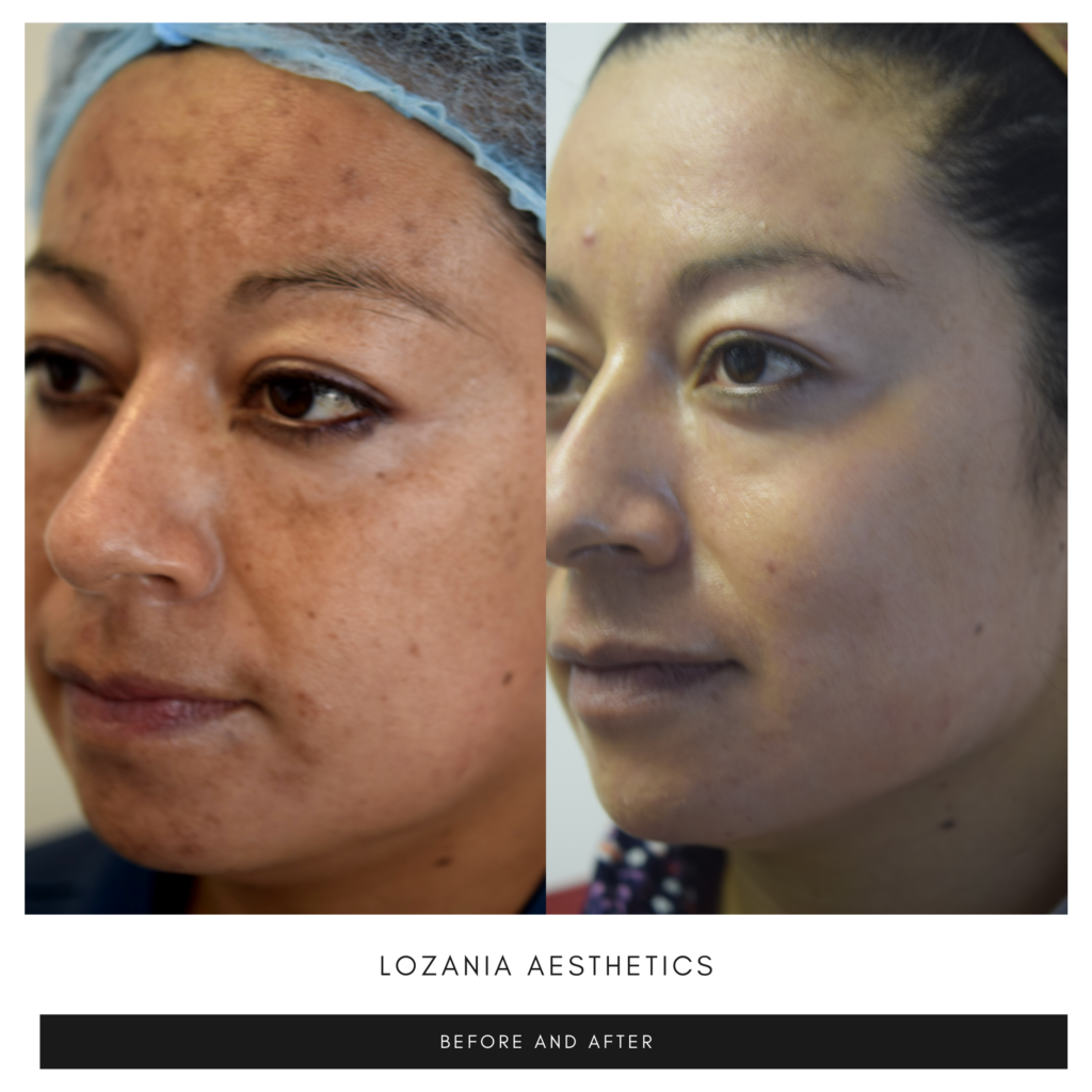 Comparativo antes y después de una mujer en tres cuartos atendida en Lozania Centro Estético: la piel luce más uniforme y luminosa, con menos manchas y poros visibles; ejemplo de medicina estética facial y tratamientos no quirúrgicos de cuidado de la piel, respaldados por evaluación médica personalizada y tecnología estética avanzada como limpieza facial, toxina botulínica o lifting no quirúrgico Liftera 2.
