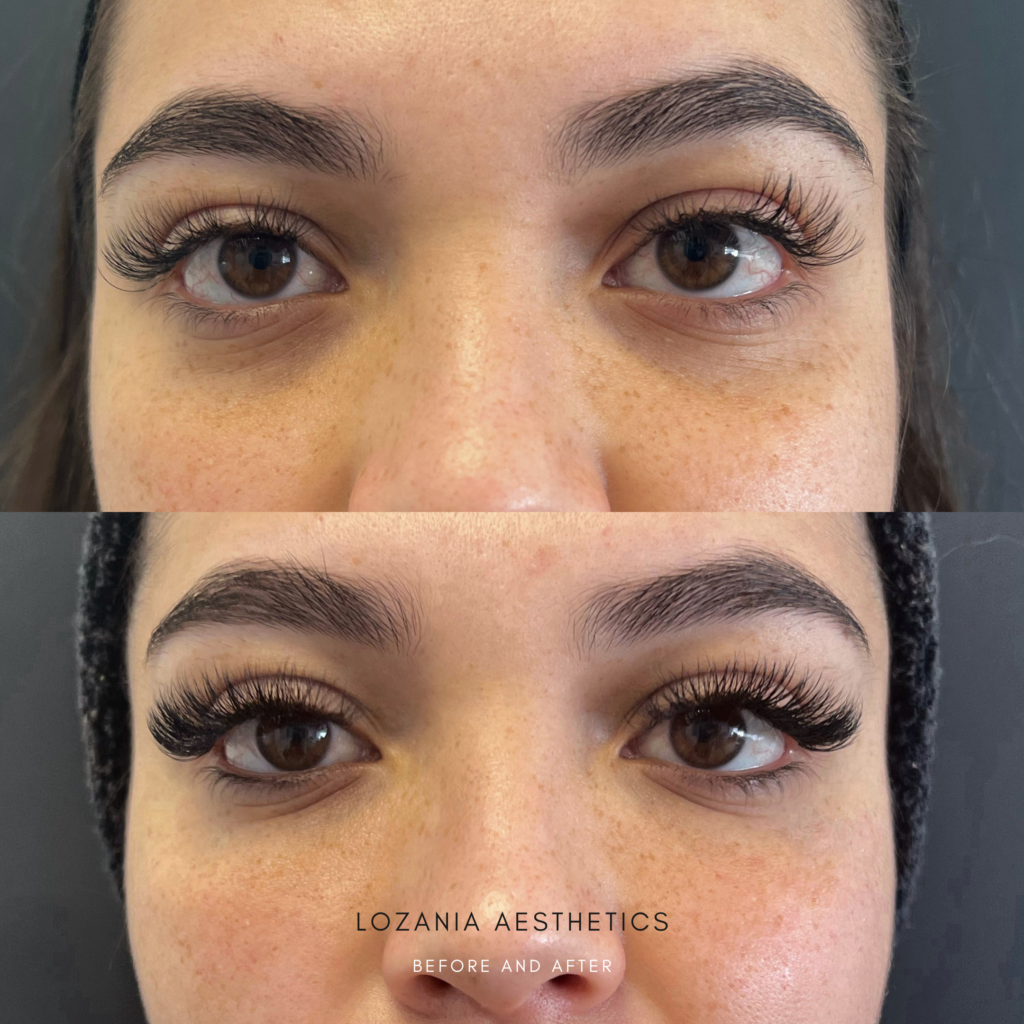 Antes y después del contorno de ojos: pestañas más largas y voluminosas, cejas definidas y piel periocular más lisa, realizado en Lozania Centro Estético; ejemplo de medicina estética facial con tratamientos no quirúrgicos y cuidado de la piel, tras evaluación médica personalizada con apoyo de tecnología estética avanzada.