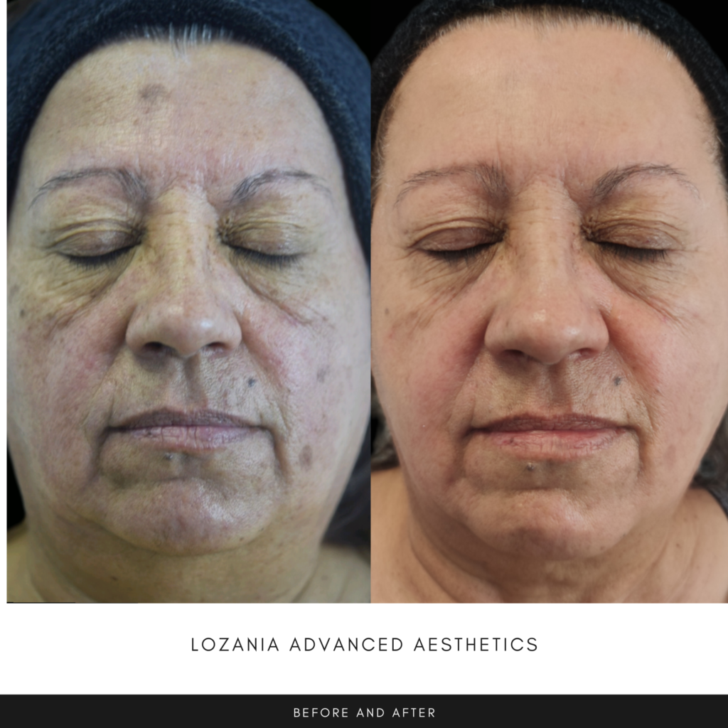 Antes y después de una paciente con ojos cerrados en Lozania Centro Estético: se aprecia piel más uniforme, manchas y poros atenuados y arrugas suavizadas en frente y surcos, resultado de medicina estética facial y cuidado de la piel con tratamientos no quirúrgicos y tecnología estética avanzada (limpieza facial, toxina botulínica, lifting no quirúrgico Liftera 2) tras evaluación médica personalizada.