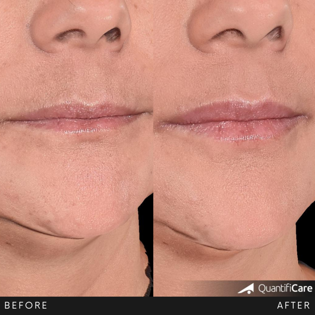 Antes y después del tercio inferior del rostro en Lozania Centro Estético: labios y mentón más definidos con textura más lisa y surcos periorales atenuados; ejemplo de medicina estética facial con tratamientos no quirúrgicos para el cuidado de la piel (toxina botulínica o lifting no quirúrgico Liftera 2), tras evaluación médica personalizada, usando tecnología estética avanzada y limpieza facial.