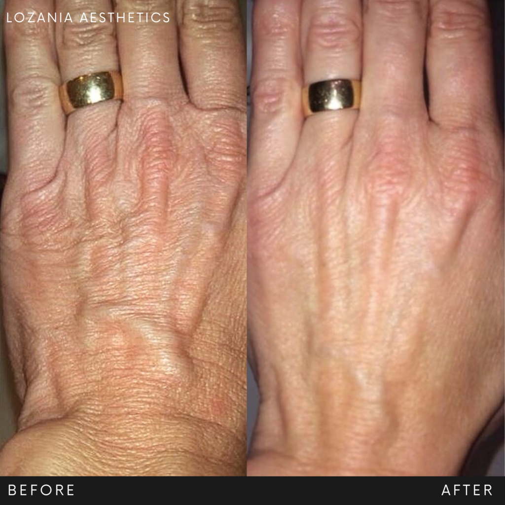 Antes y después del dorso de una mano con anillo: la piel pasa de seca y con arrugas marcadas a más lisa, hidratada y uniforme, resultado de un tratamiento no quirúrgico en Lozania Centro Estético con evaluación médica personalizada, cuidado de la piel y tecnología estética avanzada del equipo de medicina estética facial.