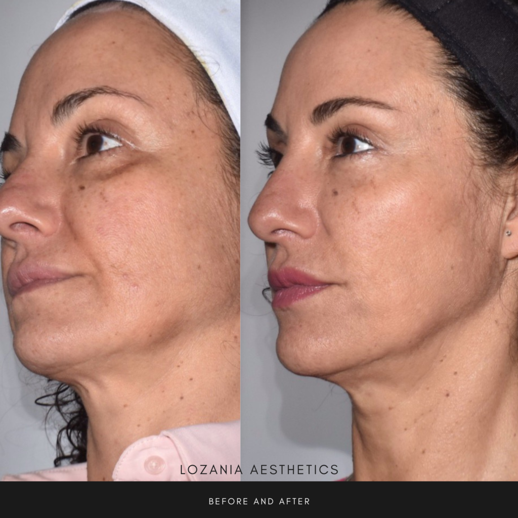 Alt text: Antes y después de un perfil facial femenino en Lozania Centro Estético, con piel más lisa, luminosidad mejorada y contorno mandibular definido; resultados de medicina estética facial y tratamientos no quirúrgicos como lifting no quirúrgico Liftera 2 y toxina botulínica, tras evaluación médica personalizada con tecnología estética avanzada.