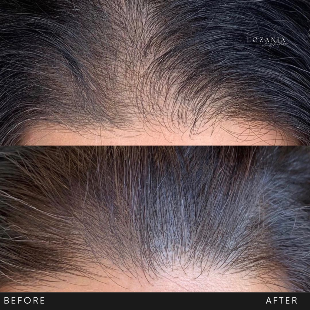 Comparativa antes y después de la línea del cabello: la frente pasa de escasa a más densa tras un tratamiento capilar no quirúrgico en Lozania Centro Estético, parte de su medicina estética facial con tecnología estética avanzada y evaluación médica personalizada, enfocada en el cuidado de la piel y cuero cabelludo.