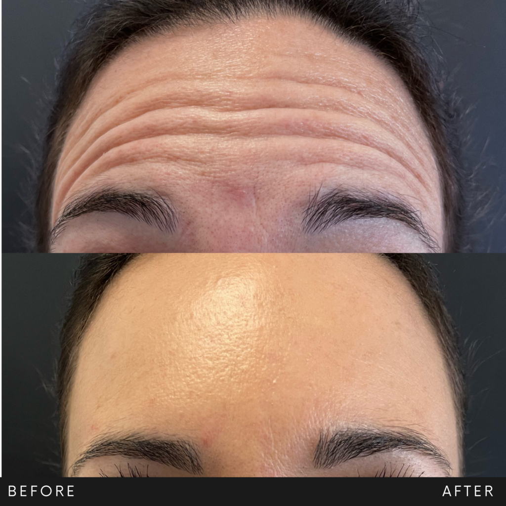 Comparativa antes-después de una frente: las arrugas horizontales marcadas se alisan tras toxina botulínica, dejando la piel uniforme y luminosa. Medicina estética facial en Lozania Centro Estético; tratamiento no quirúrgico con evaluación médica personalizada y tecnología estética avanzada para el cuidado de la piel.