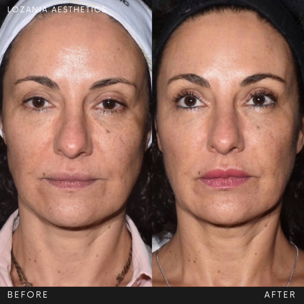 Comparativa antes y después del rostro de una paciente en Lozania Centro Estético: piel más luminosa y uniforme, contorno más firme y líneas suavizadas. Muestra resultados de medicina estética facial, cuidado de la piel y tratamientos no quirúrgicos con tecnología estética avanzada—posible combinación de limpieza facial, toxina botulínica y lifting no quirúrgico Liftera 2 tras evaluación médica personalizada.