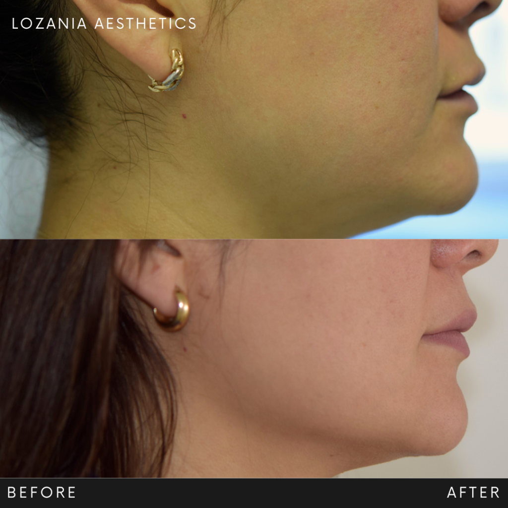 Comparativa antes y después del perfil facial inferior de una mujer en Lozania Centro Estético; se aprecia una mandíbula más definida y piel más uniforme, ejemplo de medicina estética facial y tratamientos no quirúrgicos con tecnología estética avanzada, como el lifting no quirúrgico Liftera 2, complementados por cuidado de la piel, limpieza facial, evaluación médica personalizada y, cuando procede, toxina botulínica.