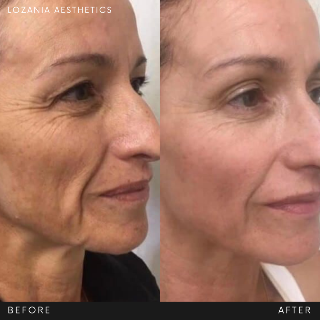 Antes y después del rostro de una mujer adulta en tres cuartos, con reducción visible de arrugas en patas de gallo y surcos nasogenianos, piel más tersa y contorno definido tras cuidados de medicina estética facial en Lozania Centro Estético; resultados de tratamientos no quirúrgicos para el cuidado de la piel realizados con tecnología estética avanzada y evaluación médica personalizada, como toxina botulínica o lifting no quirúrgico Liftera 2.