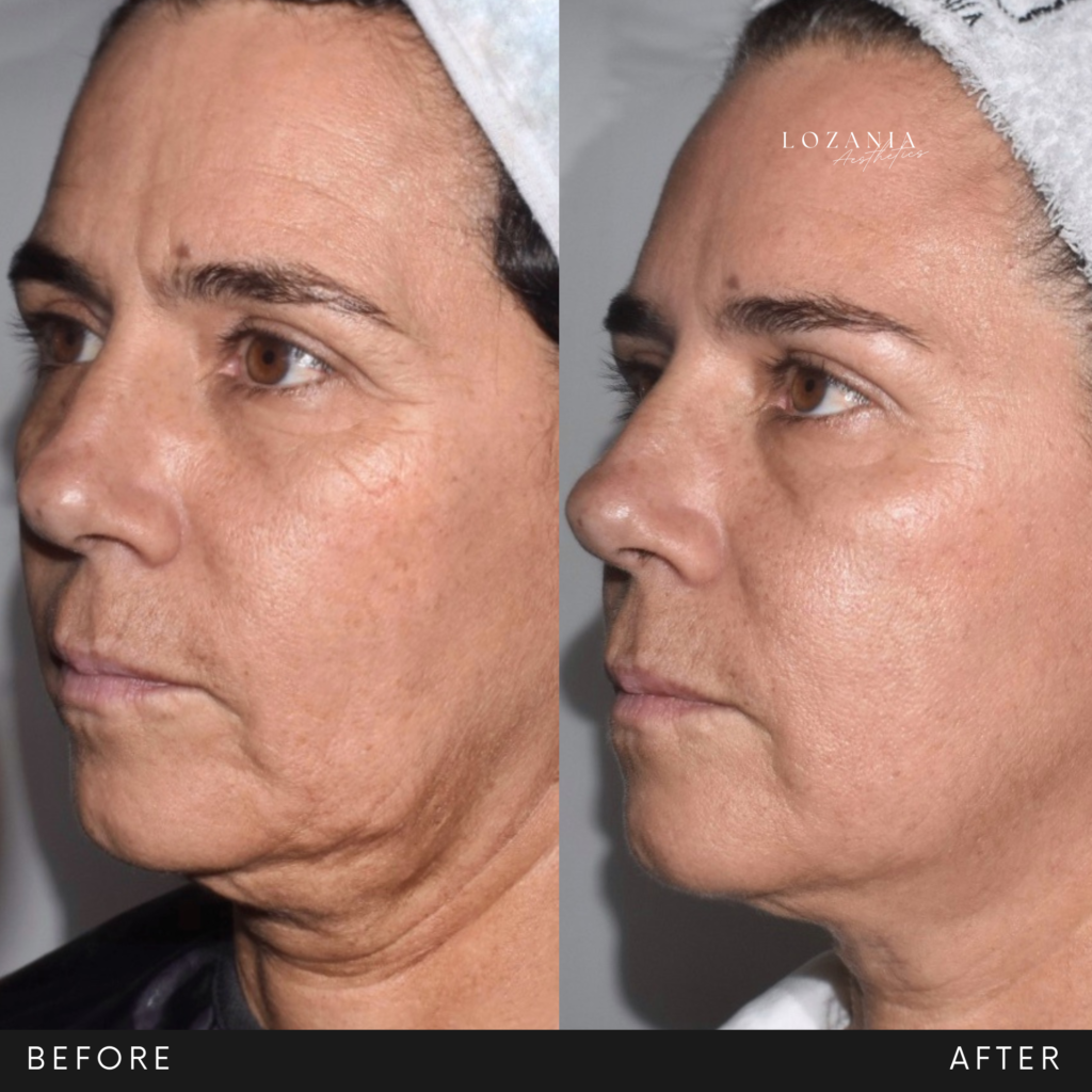 Before/After del perfil izquierdo de una persona en Lozania Centro Estético: la piel luce más uniforme y luminosa, con menor flacidez en mejillas y cuello, línea mandibular más definida y arrugas finas suavizadas. Resultado de medicina estética facial con tratamientos no quirúrgicos, como lifting no quirúrgico Liftera 2, toxina botulínica y limpieza facial, tras evaluación médica personalizada y uso de tecnología estética avanzada.