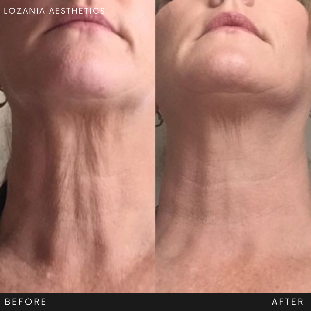 Comparativa antes y después del cuello de una persona: se reducen arrugas verticales y se observa mayor firmeza bajo el mentón. En Lozania Centro Estético, resultados de medicina estética facial con tratamientos no quirúrgicos y tecnología estética avanzada (toxina botulínica o lifting no quirúrgico Liftera 2), definidos tras evaluación médica personalizada y acompañados de cuidado de la piel y limpieza facial.