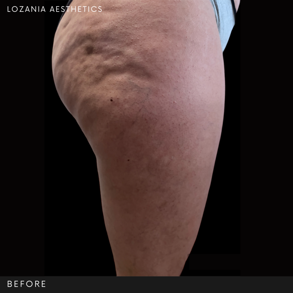 Primer plano del muslo y glúteo de una persona con celulitis marcada e irregularidades en la piel, imagen “antes” sobre fondo negro. Documenta el estado inicial en Lozania Centro Estético para tratamientos no quirúrgicos de remodelación corporal y cuidado de la piel, con evaluación médica personalizada y uso de tecnología estética avanzada.