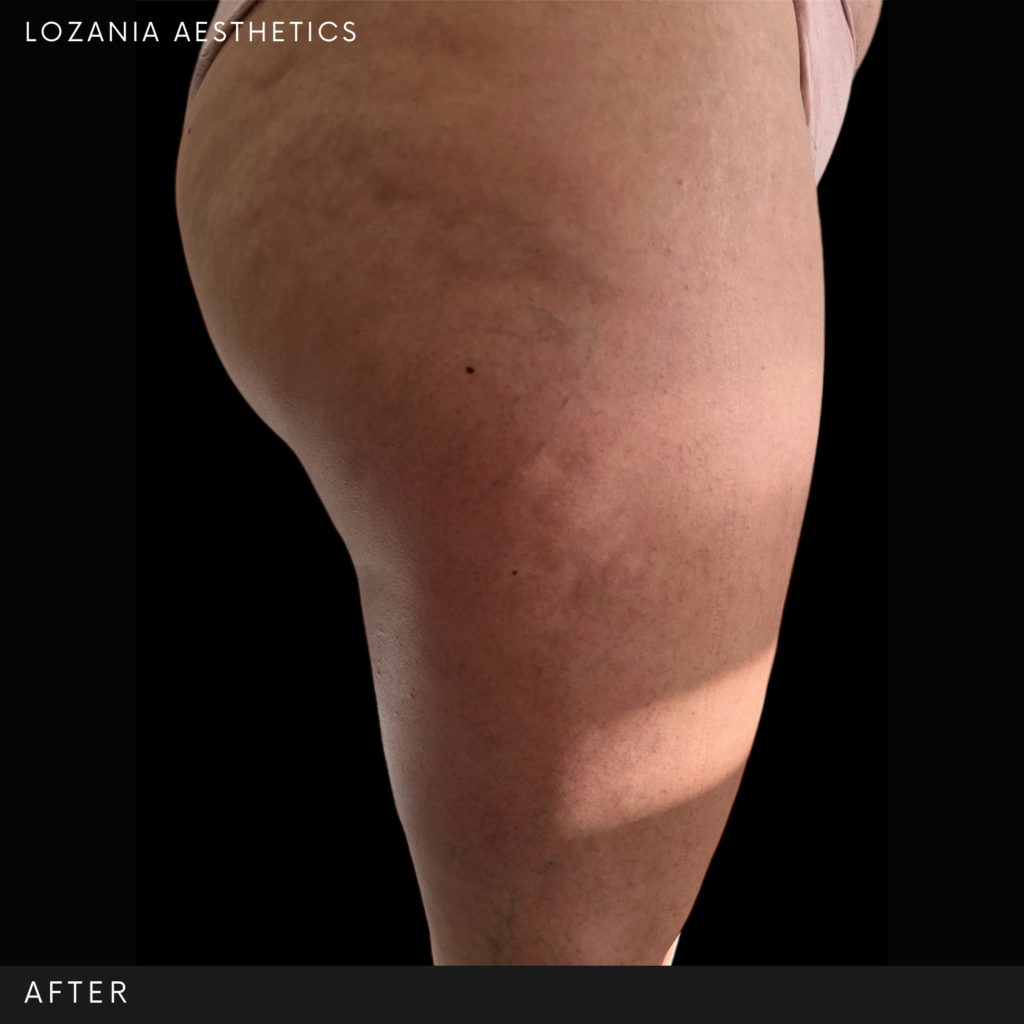 Resultado “After” de un muslo y glúteo sobre fondo negro: piel más lisa y firme, con menor celulitis tras tratamientos no quirúrgicos en Lozania Centro Estético, usando tecnología estética avanzada (lifting no quirúrgico Liftera 2) y evaluación médica personalizada para cuidado de la piel.